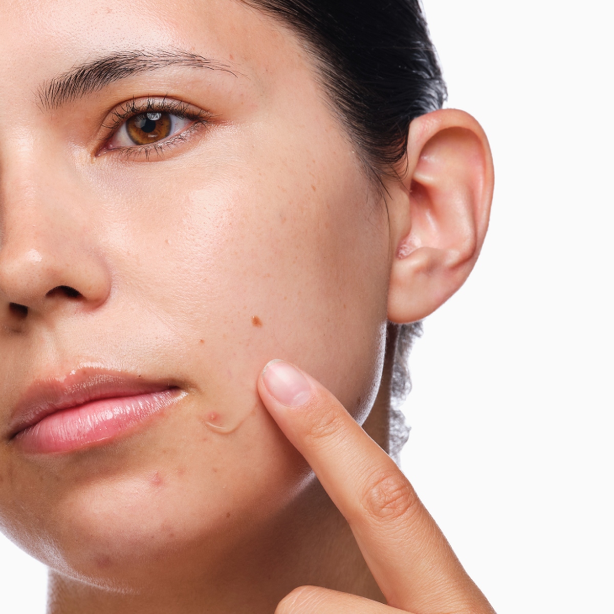 the-acne-set-b1 rdn-the-acne-set-application.png
