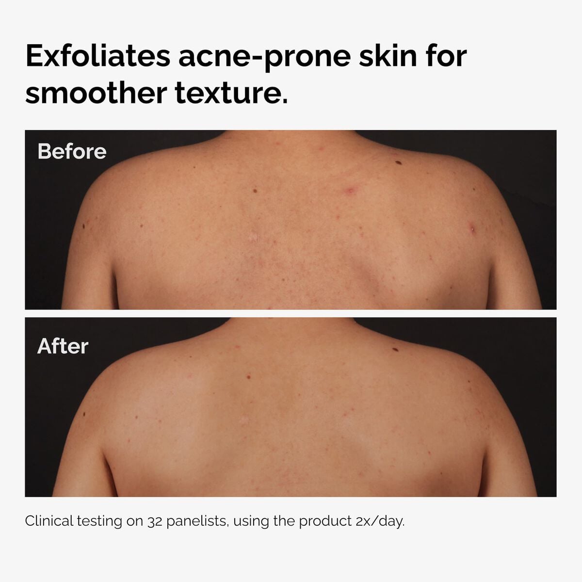 salicylic-acid-0-5-body-serum-d4 ord-salicylic-acid-body-serum-before-after-graphic-NA.jpg