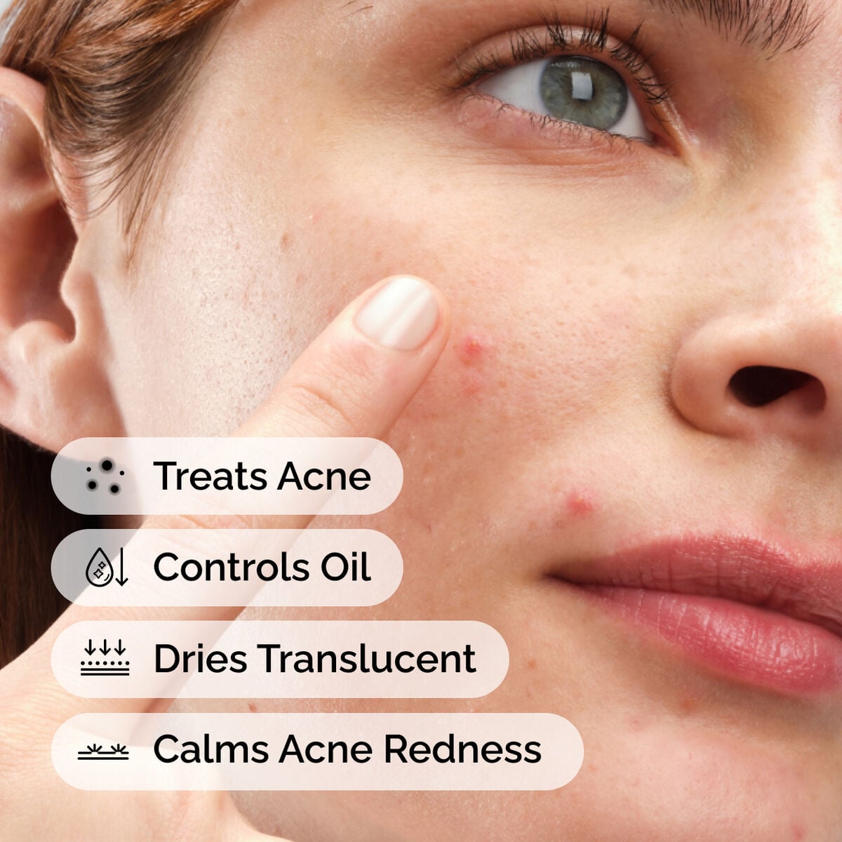 sulfur-10-powder-to-cream-concentrate-b6 ord-sulfur-10pct-powder-to-cream-concentrate-model-application-with-benefits-acne.jpg